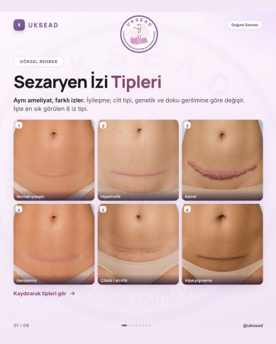 Sezaryen İzi Tipleri